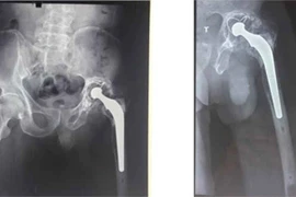 Đục xi măng “giải liệt” cho bệnh nhân hỏng khớp nhân tạo