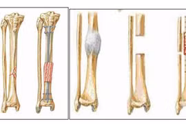 6 tháng chân gẫy chưa liền do khớp giả