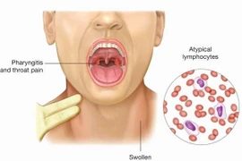 Virus EBV gây ung thư mũi họng
