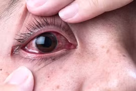 Bệnh nặng do sử dụng thuốc hết date