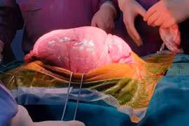 Hãi hùng với khối u khổng lồ trong ổ bụng