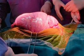 Hãi hùng với khối u khổng lồ trong ổ bụng