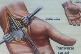 Hội chứng ống cổ tay – có thể teo cơ nếu điều trị muộn