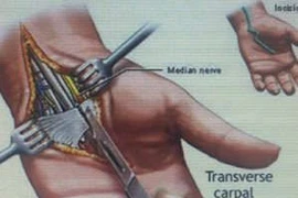 Hội chứng ống cổ tay – có thể teo cơ nếu điều trị muộn