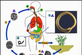 Nhiễm giun đũa gây nhiều bệnh nguy hiểm
