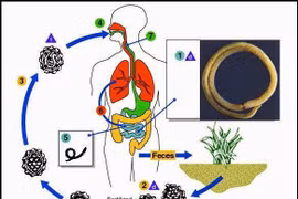Nhiễm giun đũa gây nhiều bệnh nguy hiểm