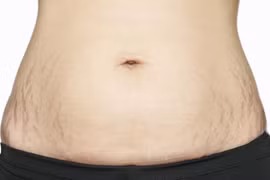 Phòng ngừa bị rạn da