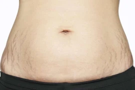 Phòng ngừa bị rạn da