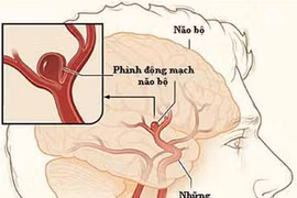 Dấu hiệu phồng, vỡ động mạch não