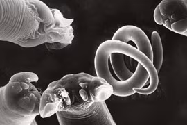 Tưởng bị bại liệt hóa ra giun xoắn