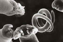 Tưởng bị bại liệt hóa ra giun xoắn