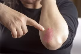 Các giải pháp từ thiên nhiên giúp điều trị bệnh vẩy nến hiệu quả tại nhà