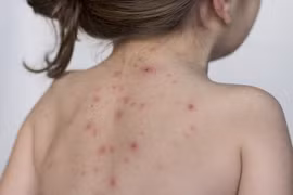 Triệu chứng thủy đậu ở trẻ em và cách điều trị