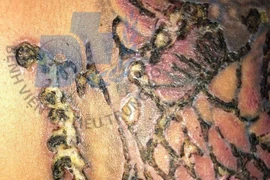 Vai nhiễm trùng vì xóa xăm