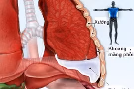 Viêm trung thất do thương tổn thực quản