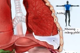 Viêm trung thất do thương tổn thực quản