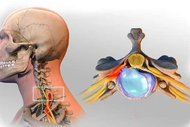 Dấu hiệu hẹp ống sống cổ với bệnh lý tủy cổ