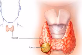 Tiêm cồn phối hợp với sóng cao tần điều trị các khối tuyến giáp lành tính