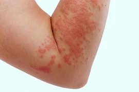Dị ứng sulfa - Coi chừng biến chứng nguy hiểm