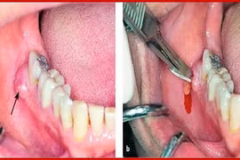 Viêm tấy vùng sàn miệng nguy hiểm tính mạng