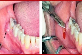 Viêm tấy vùng sàn miệng nguy hiểm tính mạng