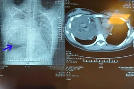 Phẫu thuật u quái chứa tóc răng xương đè xẹp phổi