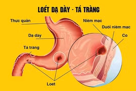  9 tuổi đã viêm loét dạ dày, hành tá tràng do vi khuẩn HP 
