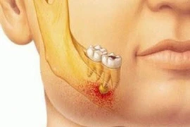 Bật mí 4 cách chữa áp xe răng hiệu quả, an toàn