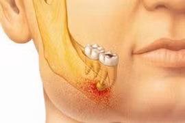 Bật mí 4 cách chữa áp xe răng hiệu quả, an toàn