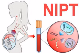 Làm NIPT, Double Test, Triple Test chẩn đoán dị tật thai nhi