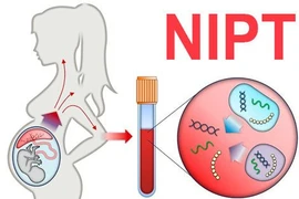 Làm NIPT, Double Test, Triple Test chẩn đoán dị tật thai nhi