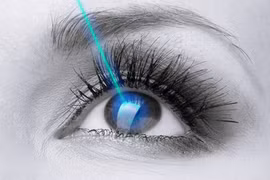 Sửa mí có phẫu thuật cận thị luôn được không?