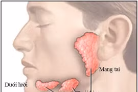 Viêm tuyến nước bọt sau uống xạ 