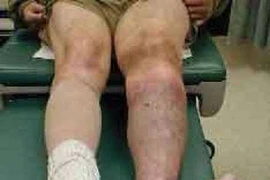 Mất chi vì biến chứng tiểu đường lại điều trị xương khớp