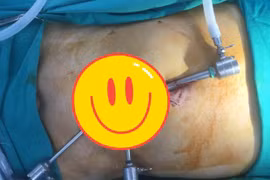 Nội soi đặt lưới điều trị thoát vị bẹn