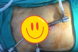 Nội soi đặt lưới điều trị thoát vị bẹn