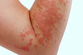 Lựa chọn thuốc trị mày đay