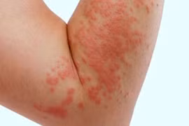 Lựa chọn thuốc trị mày đay