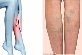 Nổi mạch máu ở chân có thể là triệu chứng của nhiều bệnh