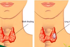 Điều trị từng thể ung thư tuyến giáp