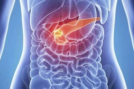 CA 19-9 giúp phát hiện sớm ung thư tụy 