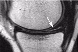 Điều trị rách sụn chêm