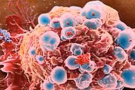 6 bệnh ung thư hay gặp ở phụ nữ