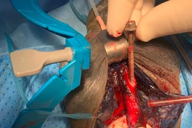 Một chiếc vít dài 6cm dính chặt vào niệu đạo người đàn ông 45 tuổi