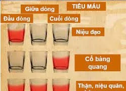 Các nguyên nhân gây đái máu