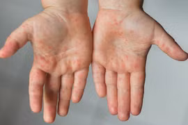 Sử dụng sản phẩm thảo dược cải thiện bệnh tay chân miệng - Xu hướng điều trị mới được chuyên gia đánh giá cao