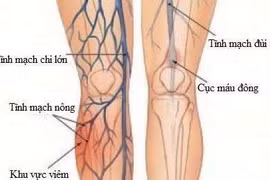 Sau đặt stent động mạch chi có cần điều trị?
