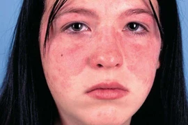 Lupus ban đỏ khó chữa, dễ biến chứng 
