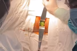 Ca hiếm gặp: Tự sướng, dưa leo kẹt lại trong hậu môn 