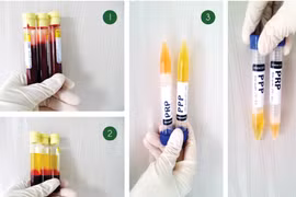 Tác dụng của tách huyết tương trong điều trị